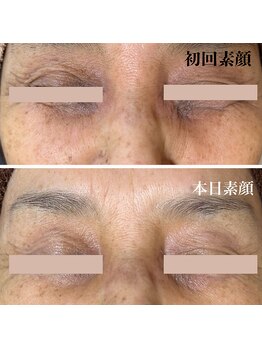 サロン ド エン(Salon de. en)/たるみケア◇ハーブピーリング