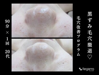 レガロビューティクリエイションズ桜川店/脱・黒ずみ！毛穴改善プログラム