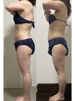 ヨルエステ(yoru aesthe)/【姿勢改善、痩身】