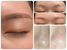 トータルビューティ ノイド(Noid)/小鼻コース＋美眉毛WAX脱毛