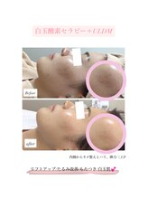 ココリル(cocorire)/白玉酸素セラピー＋ULDM (6回目)