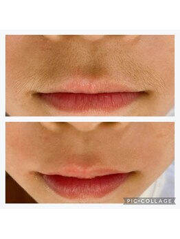 メープルサロン(MAPLE SALON)/鼻下シュガーリング