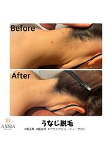 アクシア ビューティー サロン(AXSIA)/【うなじ脱毛BeforeAfter】