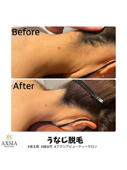 アクシア ビューティー サロン(AXSIA)/【うなじ脱毛BeforeAfter】