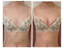 モナンジュ(ramonange)/バストアップbefore after