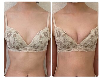 モナンジュ(ramonange)/バストアップbefore after