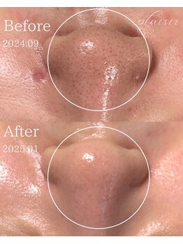 プレジール(plasir)/【毛穴集中改善】