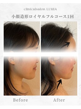 ルミア(LUMIA)/小顔造形ロイヤルフルコース１回