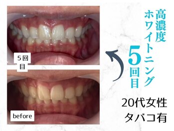 ルカノン(le canon)/清潔感のある口元になりました！
