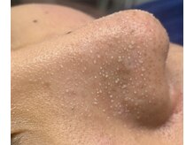 ファミリーセルフサロン 輪(Wa)/浮き出す角栓