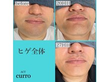 アクト クロ(ACT curro)/【ヒゲ全体】脱毛施術例