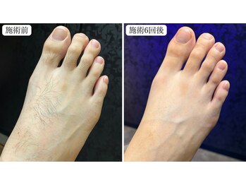 トパーズ 掛川店(Topaz)/足の指.甲脱毛