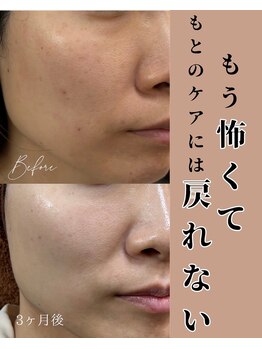 ジューンブライド(June Bride 61)/肌改善プログラム