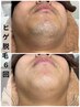 【学割U24】大人気!男性限定!ヒゲ脱毛お試し!一箇所¥1500