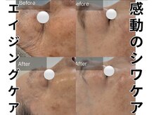 ブレア(Blair)/アルジルリン×LED光