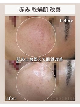 ココリール/乾燥肌・赤み