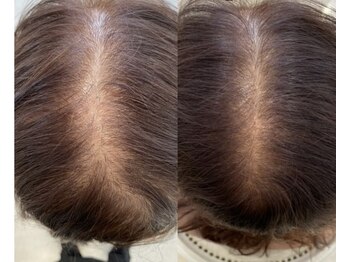 カナエル ビューティーサロン(Canael Beauty salon)の写真/マイクロニードル施術で細胞レベルから根本スピード改善！生え際や頭頂部、M字、抜け毛でお悩みの方は◎