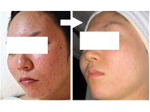 サロンドエステケイワイ(de KY)/フェイシャル☆ニキビ改善