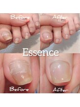 エッセンス (Essence)/歩き方などによる食い込みの補修