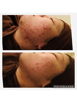 スノースキン(Snow skin)/【短期間でも別人肌】