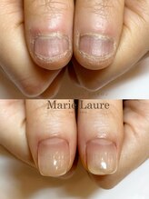 マリーロール 梅田店(Marie Laure)/深爪矯正/自爪育成/自爪風