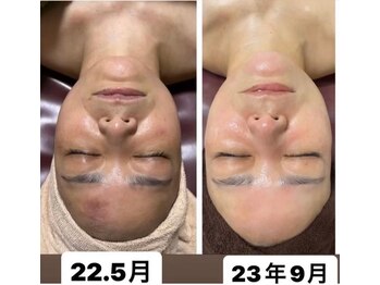 ピエノローサ(Pieno Rosa)/REVI★ハーブピーリング