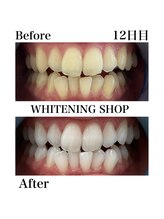 ホワイトニングショップ 日進店/Before After　12日目のお客様