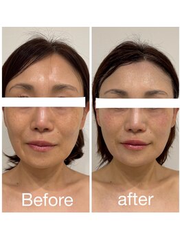 ありひ/オーダーメイドフェイシャル効果