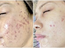 パルファンカルム 駅西本町店/長年の肌悩みが改善！