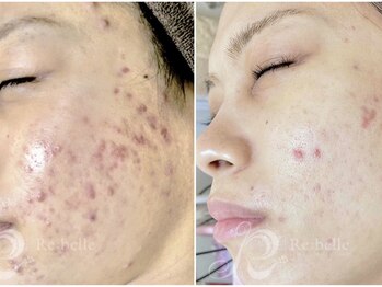 パルファンカルム 駅西本町店/長年の肌悩みが改善!