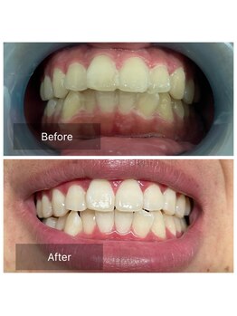 脱毛サロン メンズ 堂々/ホワイトニング