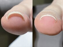 【nail】巻き爪補正でお悩み解決！（フット）
