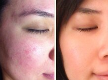 ノットノット 自由が丘(Not Knot)の雰囲気（グリーンピール5days ＋ リンパストレッチ/赤み/肌トラブルケア）