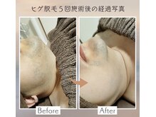 ～脱毛経過写真～