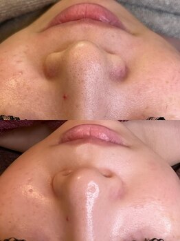 リル(LIL)の写真/気になる毛穴汚れ・黒ずみ・たるみも当店で改善◎かつてないほどの透明感溢れる美肌に☆