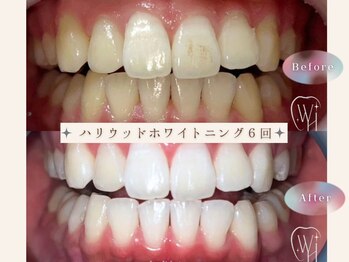 ビーモア(be more)/ホワイトニングBefore After