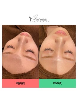 リノレリチア 心斎橋 新町店/KMP剥離なしピーリング