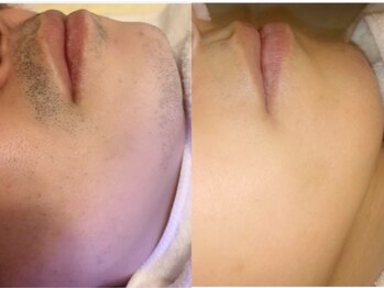 ヴィーヴ 京橋(vive)/【脱毛】ひげ7回目