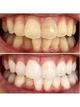 ウルル(Ululu)/ホワイトニング