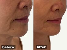 ココモンド(COCOMONDO)/幹細胞フェイシャル/エイジング