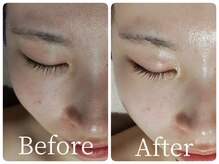 サロン ド ヒノキ(Salon de HINOKI)/毛穴レス☆ハーブピーリング