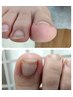 【前回巻き爪矯正を受けられた方限定】巻き爪矯正＋ネイルケア