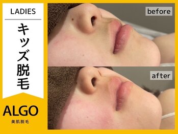 アルゴ 福井店(ALGO)/キッズ口周り脱毛　5回目