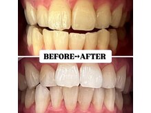 ホワイトニングサロン 豊中/Before&After美白ホワイトニング