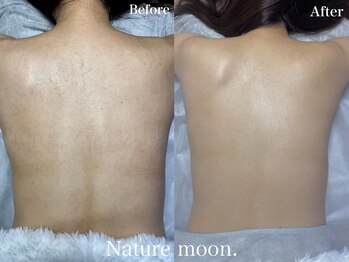 ナチュールムーン(Nature moon.)/背中ハーブピーリング