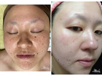 サロンドール(SalonDoll)/3ヶ月での驚きの変化