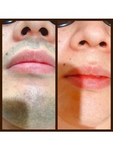 リアンジュ/ヒゲ脱毛の経過