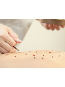 鍼灸施術を受けたい