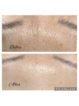 フリージア(Beauty Salon Freesia )/美肌菌活ピール1回　額シワ改善