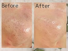 毛穴のケア得意です◎